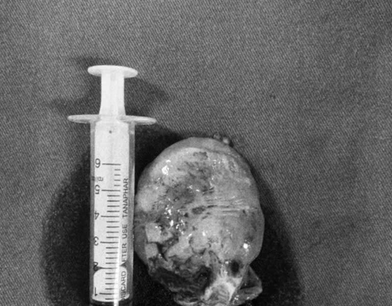 Đi khám zona thần kinh, người phụ nữ bất ngờ phát hiện khối u khổng lồ trong tim