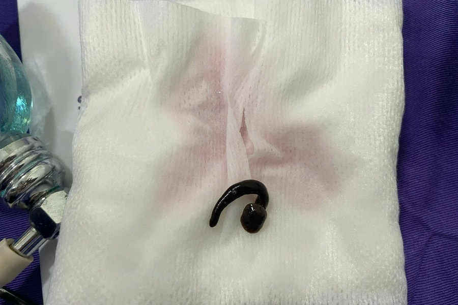 Thói quen tắm suối, nhiều trẻ nhập viện vì bị đỉa chui vào đường thở