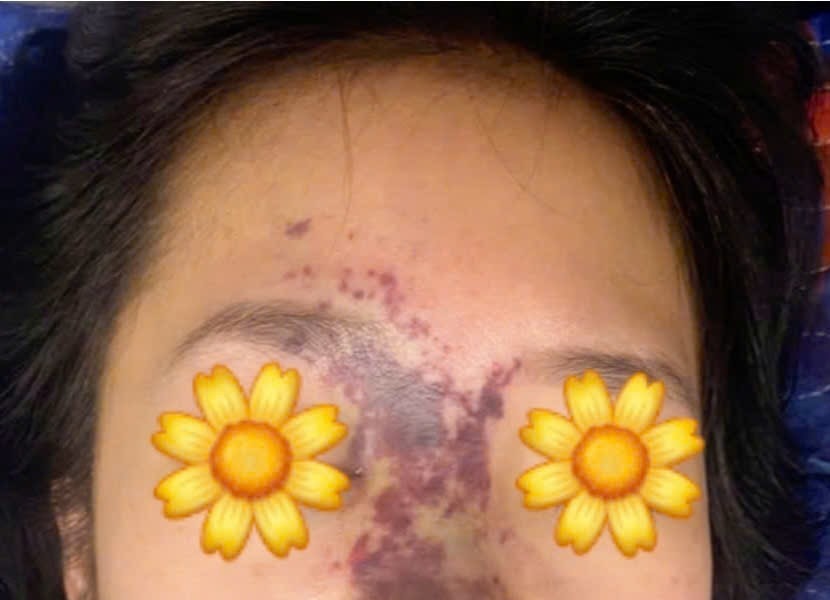 Biến chứng nặng vì phẫu thuật thẩm mỹ tại các cơ sở tư nhân không đảm bảo an toàn