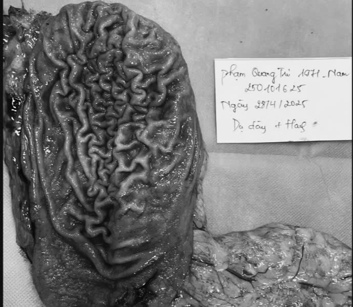 Bệnh viện K phẫu thuật thành công người bệnh mắc 2 loại ung thư