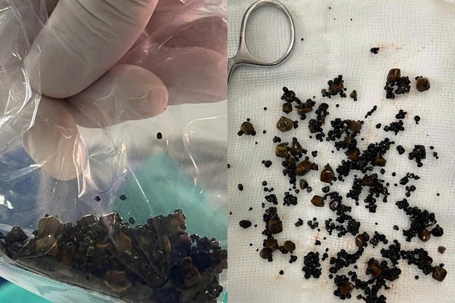 Lấy hàng trăm viên sỏi trong túi mật 2 ngăn hiếm gặp cho người phụ nữ