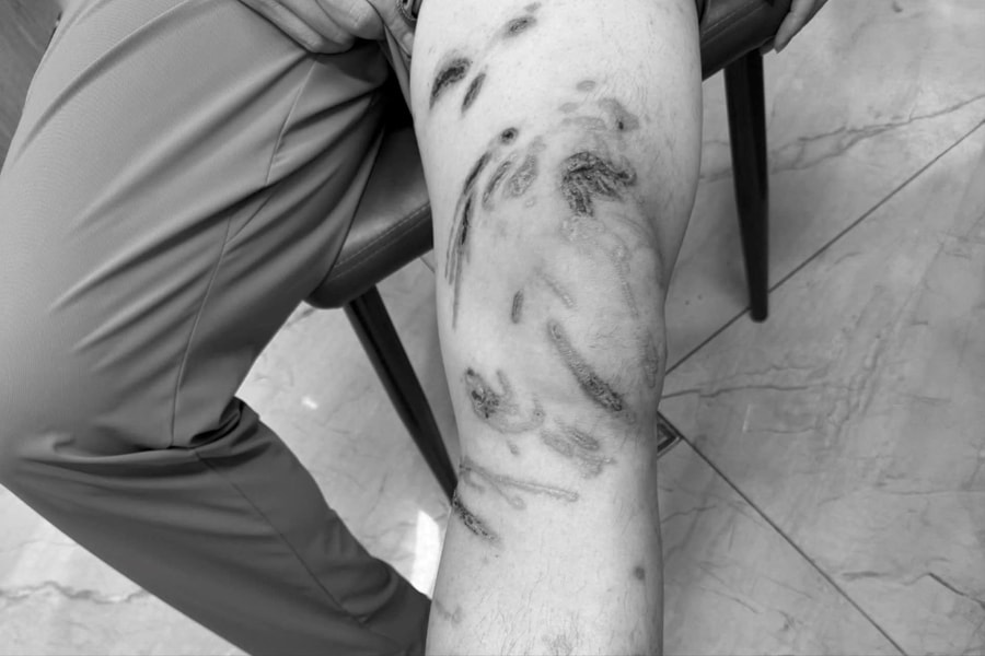 Nam thanh niên bỏng rát vì sứa chích, bác sĩ cảnh báo tai nạn da liễu mùa hè