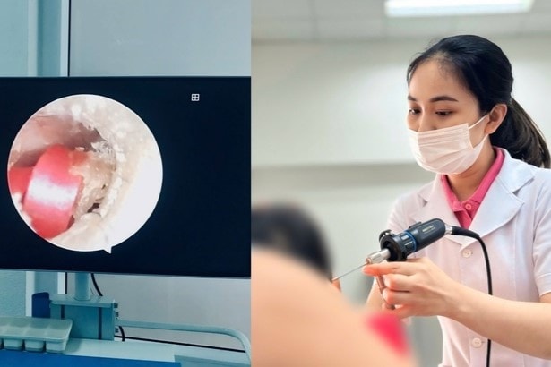 Bé gái 6 tuổi suýt thủng màng nhĩ vì một sợi dây buộc tóc