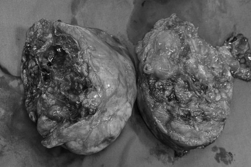 Sau cơn tức ngực, người đàn ông bất ngờ phát hiện khối u trung thất khổng lồ