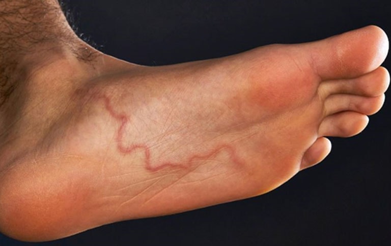 Bệnh giun rồng tái xuất : Cách nhận biết và phòng ngừa hiệu quả