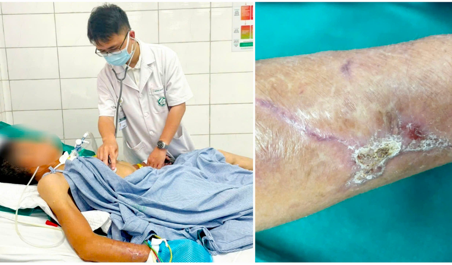 Nguy hiểm uốn ván từ vết thương ngoài da do dị vật đâm