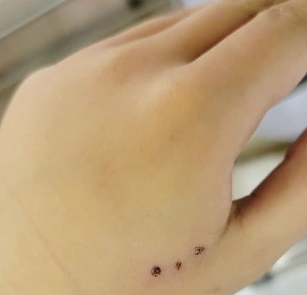 Bé trai 10 tuổi nhập viện vì chuột cắn