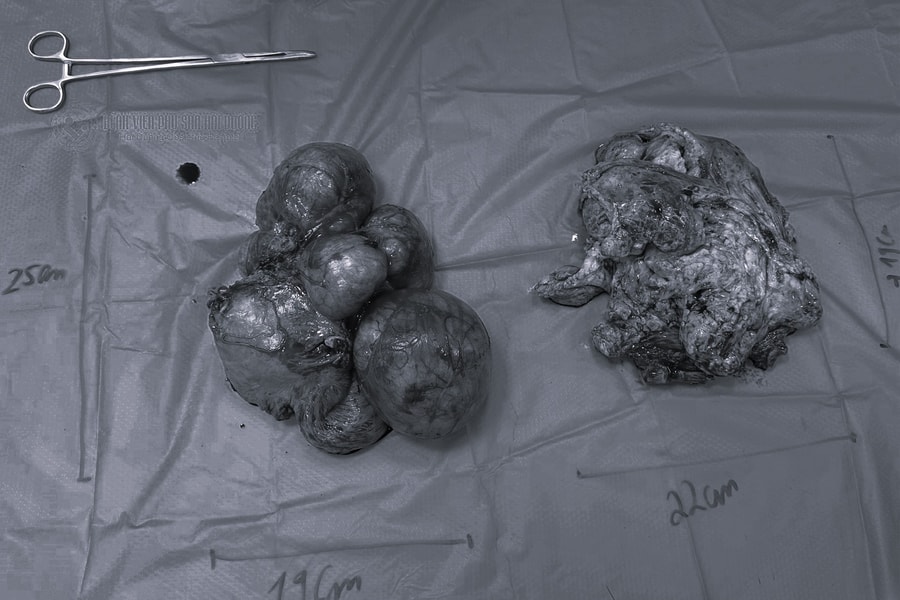 Phát hiện bụng to bất thường, người phụ nữ 37 tuổi mang khối u nặng như em bé sơ sinh