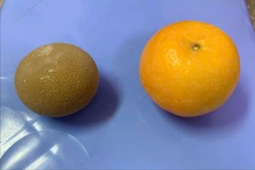 Viên sỏi bàng quang to bằng quả cam trong cơ thể người đàn ông