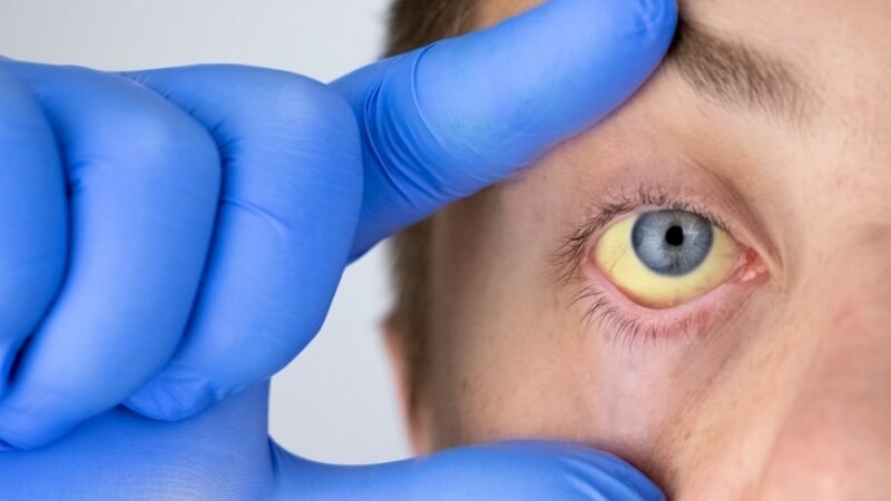 Sốt vàng: Bệnh nguy hiểm do virus, lây qua muỗi vằn