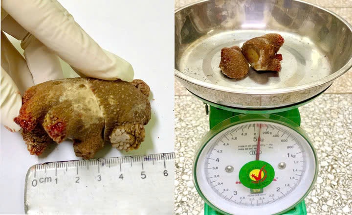 Viên sỏi “khổng lồ” như san hô trong thận bệnh nhân suốt 20 năm