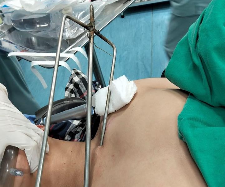 Cứu sống bệnh nhân bị xiên vịt nướng đâm xuyên cổ
