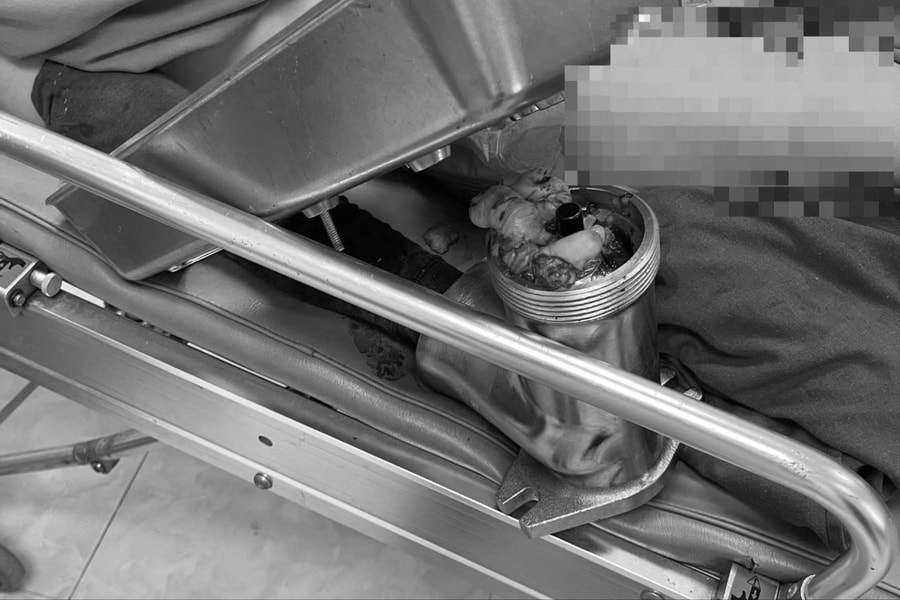 Cấp cứu bệnh nhân bị máy xay thịt cuốn trọn bàn tay phải