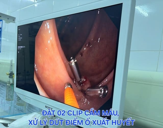 Bệnh viện Cẩm Phả cấp cứu thành công ca xuất huyết nguy kịch giữa lúc ứng trực bão số 3