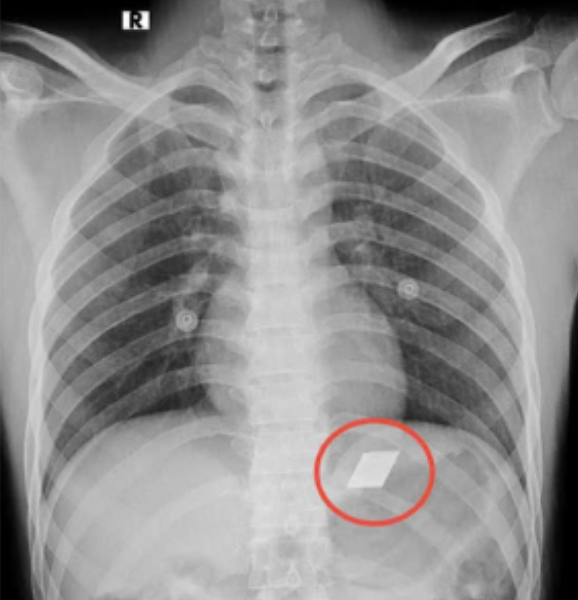 Cấp cứu nam thanh niên 26 tuổi nuốt dao rọc giấy và dao lam