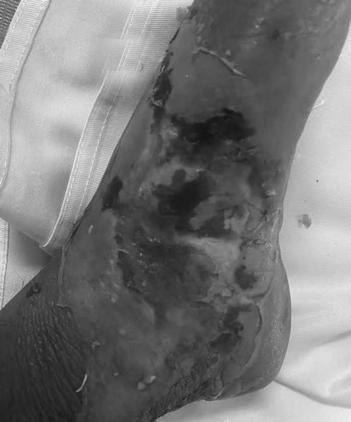 Người đàn ông nhiễm trùng nặng vì tự ý đắp thuốc sau khi bị rắn cắn