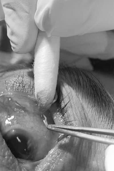 Hy hữu: Giun dài 4cm “ẩn náu” trong mắt người phụ nữ 67 tuổi