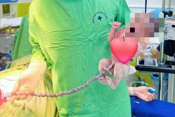 Thai nhi thoát khỏi cửa tử nhờ dây rốn dài khoảng 1 mét, hiếm gặp