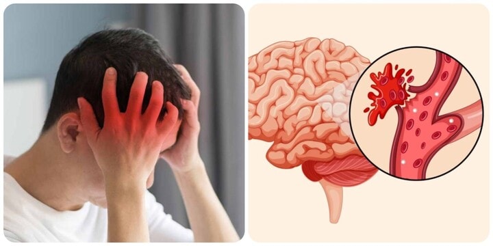 Can thiệp “giờ vàng”: Chìa khóa cấp cứu bệnh nhân đột quỵ