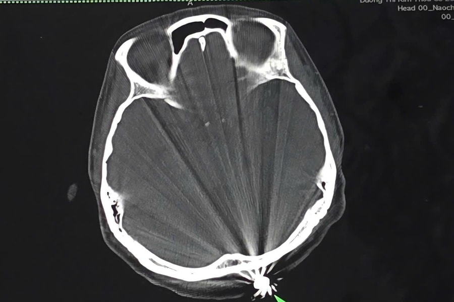 Phẫu thuật thành công cho phụ nữ bị viên đạn lạc găm vào đầu khi đang làm vườn
