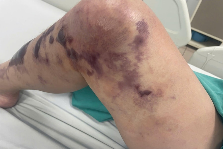 Từ vết trầy xước nhỏ ở chân tưởng vô hại, người phụ nữ sốc nhiễm trùng nguy kịch