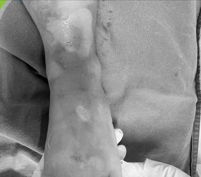 Bác sĩ khuyến cáo: Cẩn trọng tai nạn bỏng nước sôi ở trẻ nhỏ