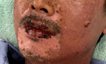 Bỏng toàn thân, mù tạm thời vì nước mưa lẫn silicon trút từ mái tôn xuống người