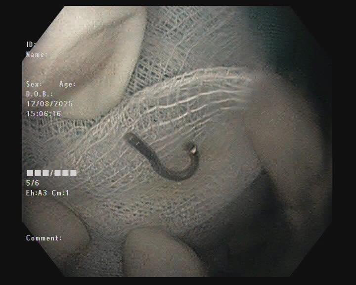 Bé trai 5 tuổi thoát nguy hiểm sau khi nuốt móc cài vòng bạc