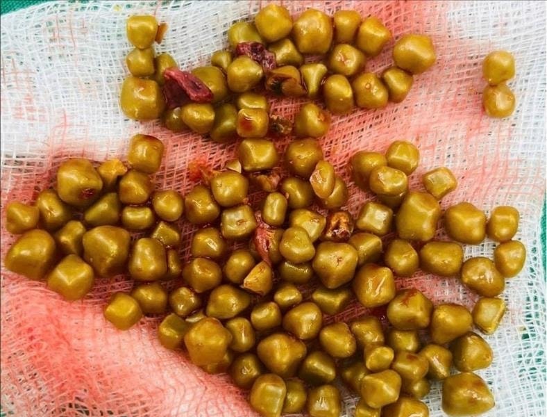 Mổ cấp cứu nữ bệnh nhân có hơn 100 viên sỏi chứa đầy trong túi mật