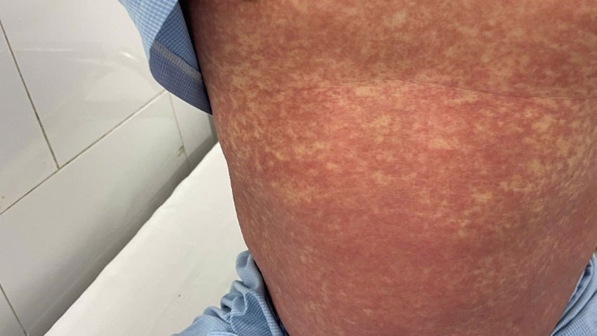 Bộ Y tế cảnh báo không mua, bán hoặc sử dụng thuốc chứa Phenylbutazone