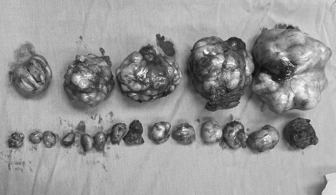 Hiếm gặp: Bóc tách 19 khối u xơ tử cung cho nữ bệnh nhân 32 tuổi