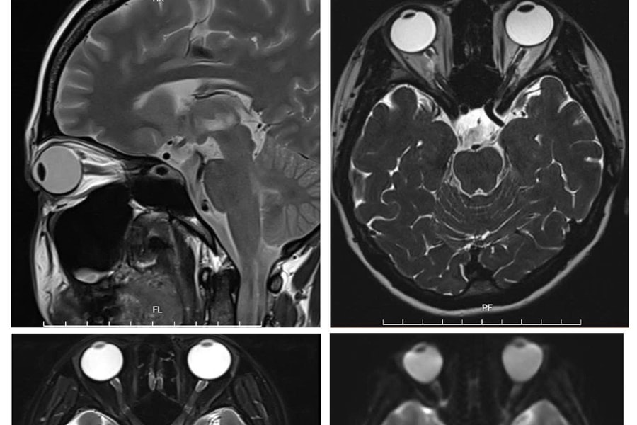 “Giải thoát” nữ bệnh nhân khỏi bệnh rối loạn phổ viêm tủy thị thần kinh thể hiếm gặp