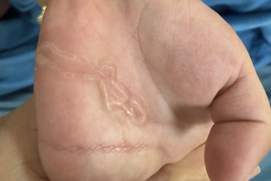 Bé trai 4 tuổi xuất hiện "đường ngoằn ngoèo" trên tay, nhập viện vì nhiễm sán máng