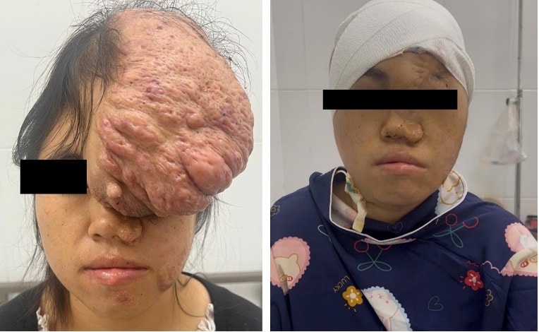 Khối u khổng lồ khiến khuôn mặt cô gái biến dạng suốt 15 năm