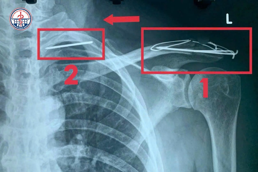 Hi hữu: Đinh phẫu thuật 'lang thang' trong lồng ngực bệnh nhân