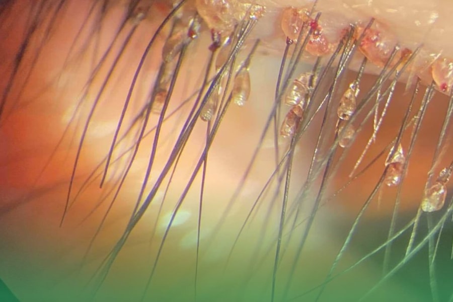 Chuyên gia cảnh báo tình trạng rận mi ở trẻ nhỏ