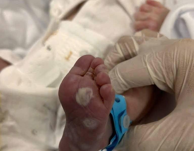 Trẻ sơ sinh mắc giang mai bẩm sinh: Hồi chuông cảnh báo tầm soát thai kỳ