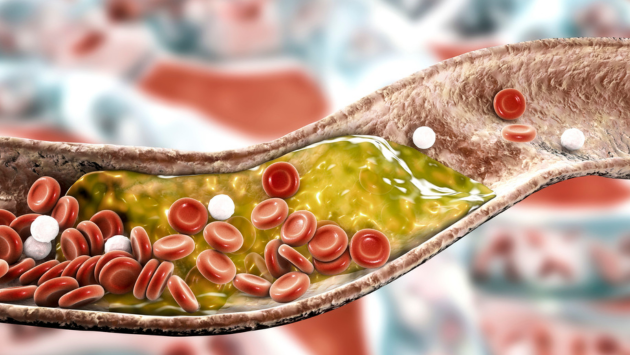 Vì sao ăn chay nhưng vẫn bị tăng mỡ máu ?