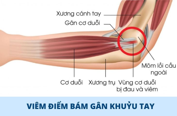 Không chỉ dân thể thao, ai cũng dễ mắc viêm gân khuỷu tay
