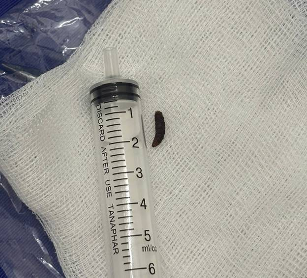 Bé 14 tháng tuổi quấy khóc dữ dội, bác sĩ phát hiện dòi sống trong tai