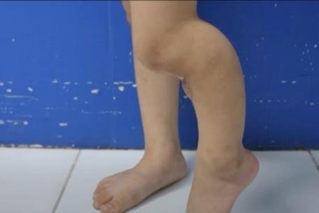 Bố mẹ đắp lá theo cách dân gian khiến trẻ bị khuyết xương