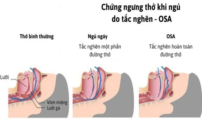 Ngáy to, buồn ngủ ban ngày: Dấu hiệu của hội chứng nguy hiểm OSA