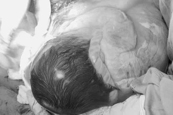 Khoảnh khắc kỳ diệu: Bé chào đời trong bọc ối hiếm gặp khoảng 1/100.000 ca sinh