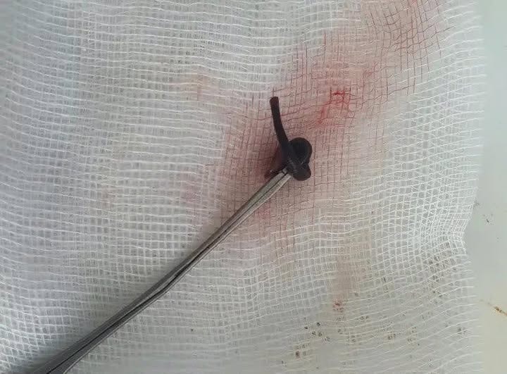 Ngạt mũi cả tuần, đi khám phát hiện vắt dài 3 cm trong hốc mũi