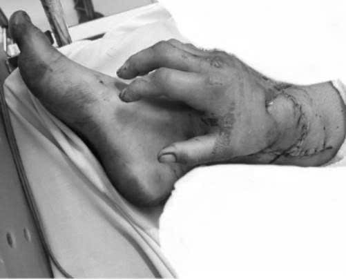 Ghép tạm tay đứt lìa vào chân để bảo toàn cho  sản phụ bị tai nạn lao động mang song thai