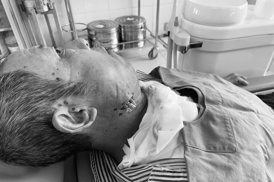 Tự ý đốt nhiệt chữa đau răng, nam bệnh nhân đối mặt nguy cơ tử vong