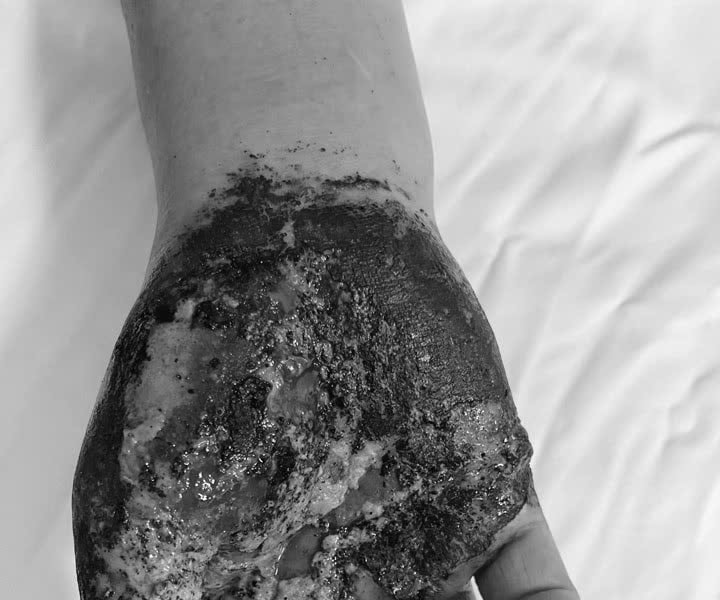 Nhiễm trùng nặng sau khi chữa vết thương bằng lá cây