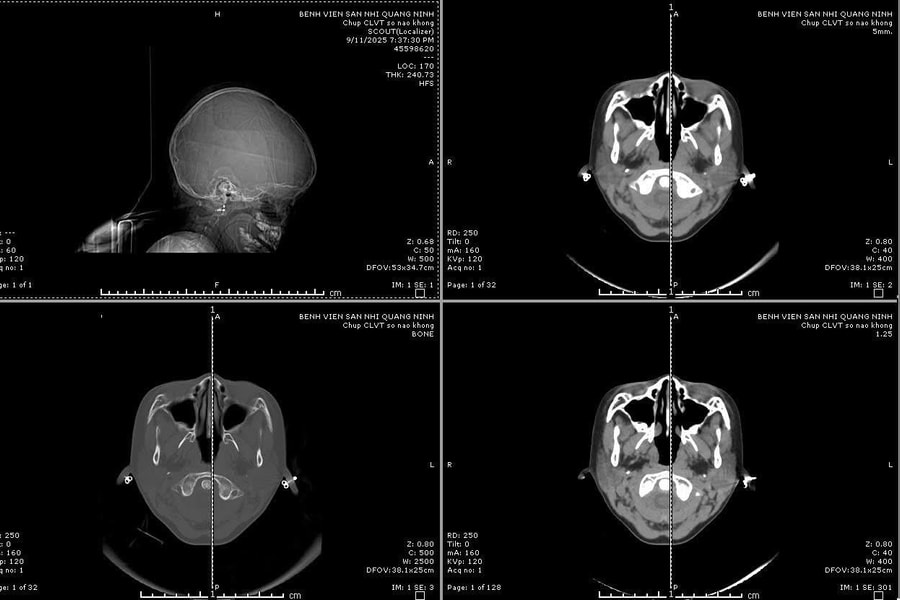 Kích hoạt "báo động đỏ" cứu sống bệnh nhi vỡ sọ phức tạp
