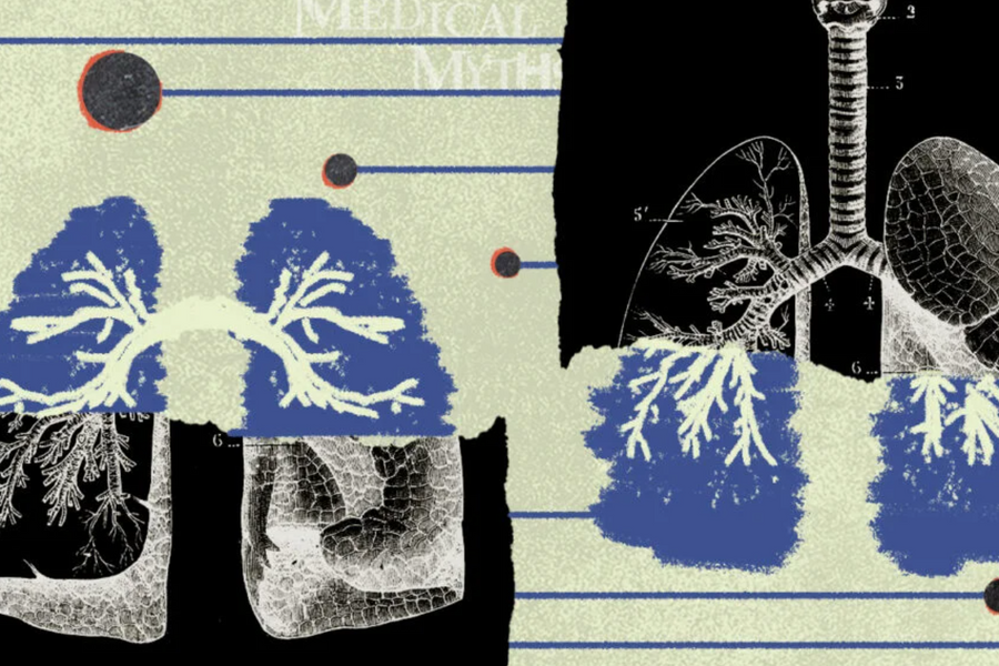 7 hiểu lầm thường gặp về ung thư phổi và sự thật cần biết