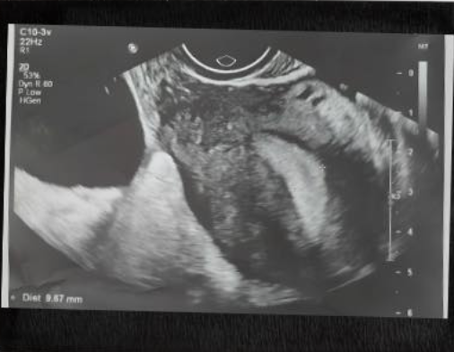 Chủ quan với cơn đau bụng bất thường, người phụ nữ suýt mất khả năng làm mẹ